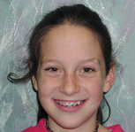 braces photo