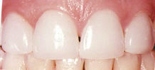 Veneers