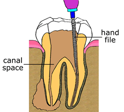 Root Canal Therapy